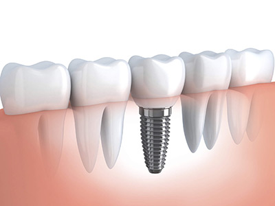 implante dentário implante dentário