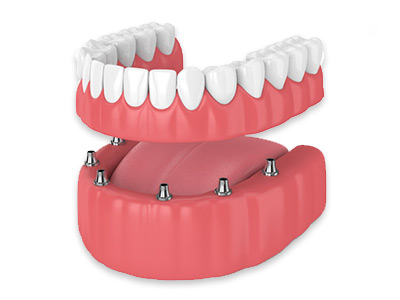 prótese dentária prótese dentária