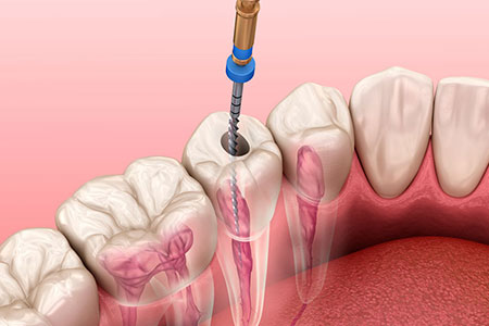 Tratamento de canal endodontia