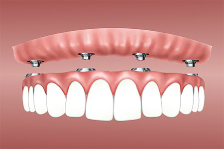 Implante total ou parcial dos dentes implantodontia