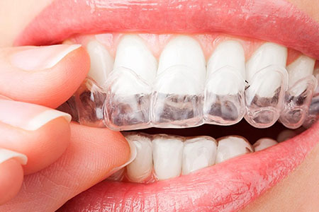 Alinhamento dos dentes com uso de aparelhos otodontia