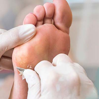 tratamento para calos e pés ressecados tratamento para calos e pés ressecados