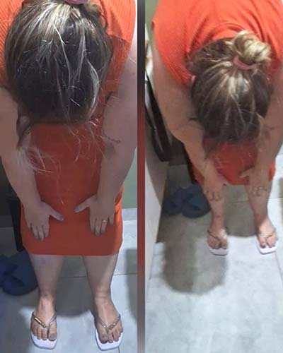 liberação miofascial antes e depois liberação miofascial antes e depois