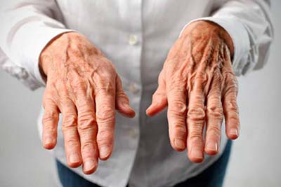 Parkinson