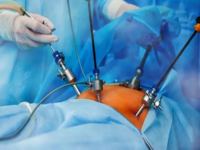 Cirurgia por vídeo Laparoscopia
