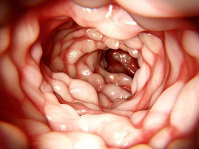 Doença diverticular dos cólons Doença diverticular dos cólons