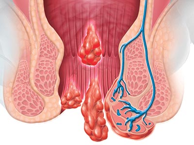 Hemorroida e fissura anal Hemorroida e fissura anal