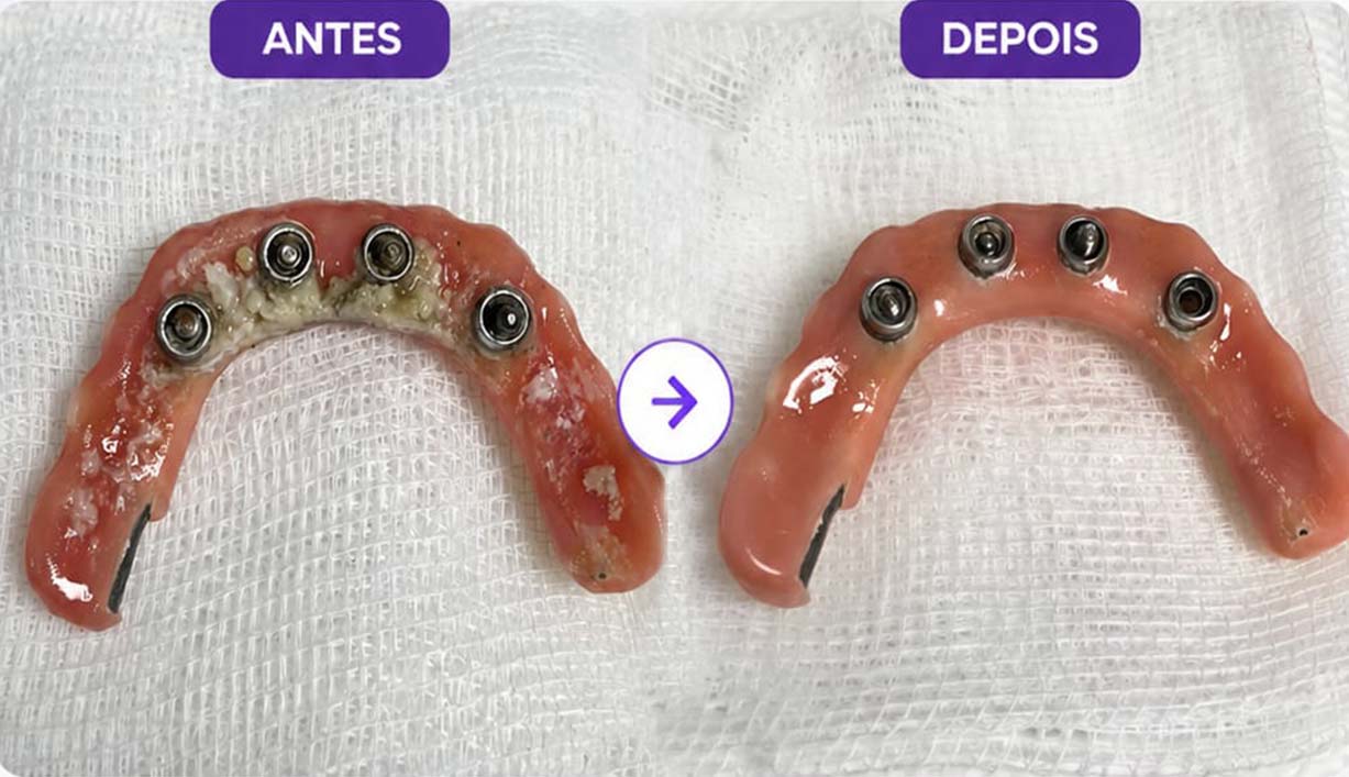limpeza de protocolo dentário limpeza de protocolo dentário