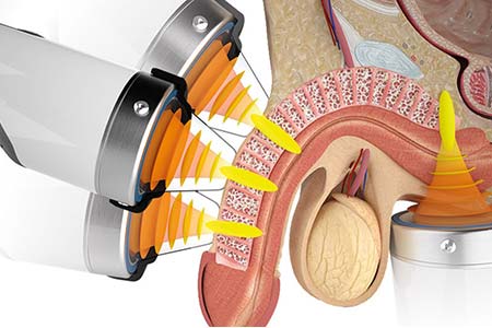 Terapia de ondas de choque peniana terapia de ondas de choque peniana