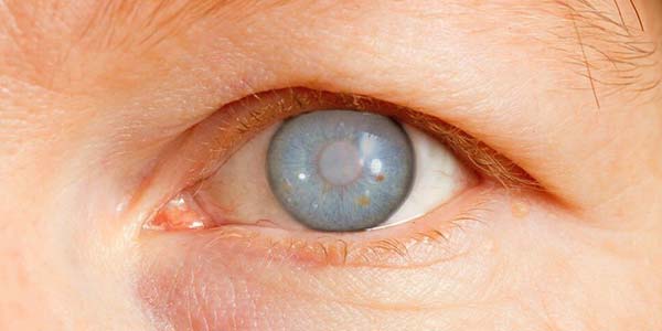 Glaucoma Glaucoma