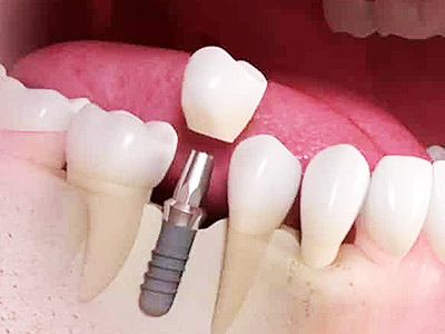 implantes dentais implantes dentais