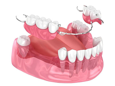 prótese dental prótese dental