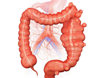 doença diverticular e diverticulite doença diverticular e diverticulite