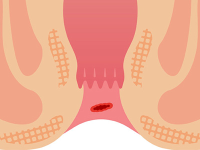 fissura anal fissura anal