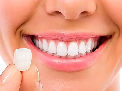 lente de contato dental