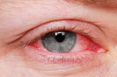 Glaucoma