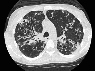 Bronquiectasia Bronquiectasia