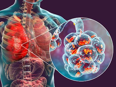 Pneumonia Pneumonia