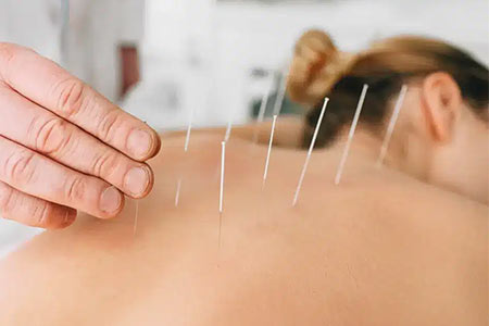 acupuntura para aliviar dores
