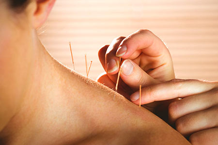 acupuntura para fibromialgia