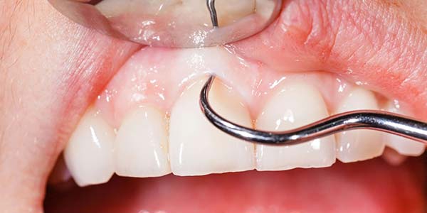 Prevenção e tratamento gengival em Presidente Prudente Limpeza dental e tratamento da gengiva