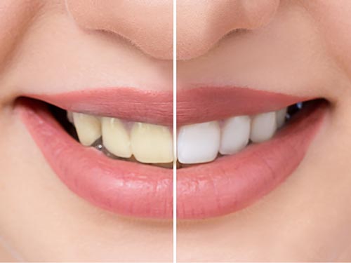 Clareamento dos dentes Clareamento dentário