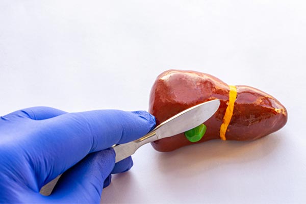 Cirurgia de vesícula Modelo anatômico de fígado e vesícula com bisturi, representando a retirada da vesícula