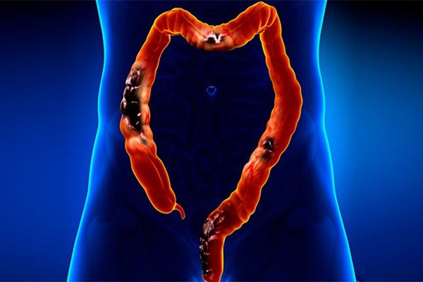 Ilustração do intestino grosso com lesões escuras, representando tumores do aparelho digestivo
